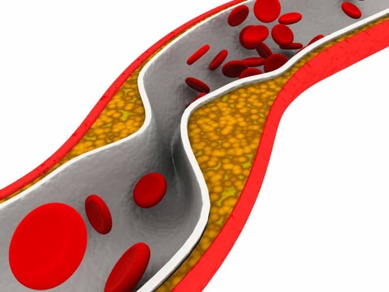 Hypertriglycéridémie