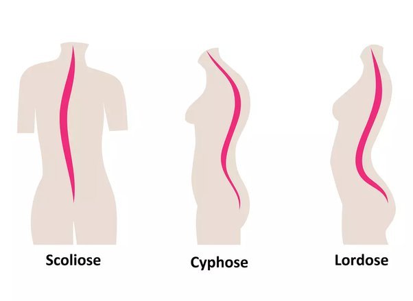 Scoliose