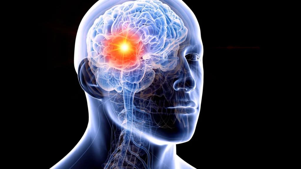 Tumeur au Cerveau