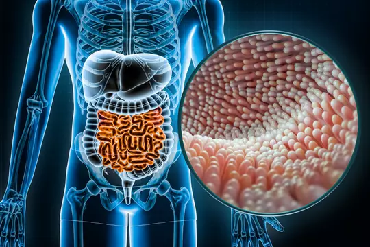 cancer colorectal